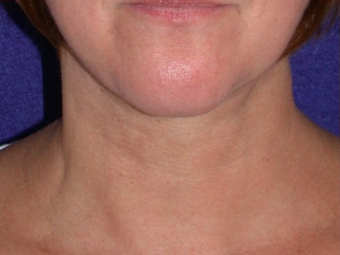 Necklift after 208441