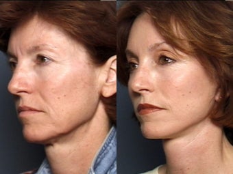 Brow Lift after 337413