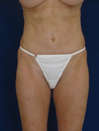 vaser Hi Def Liposuction of chest, abdomen, back and flanks before 422723
