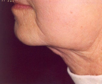 Lipodissolve and CoolSculpting after 429756