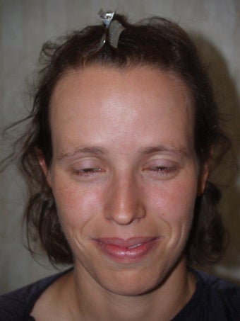 Hair Transplant / Hairline Advancement before 230329