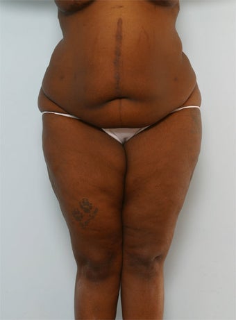 Body Lift before 260133