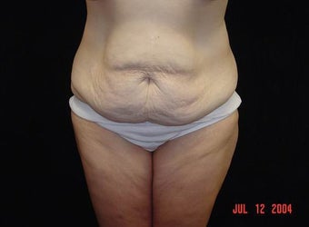 Body Lift with Liposuction of Abdomen, Waist, Flanks before 203460