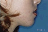 Chin Implants after 357645