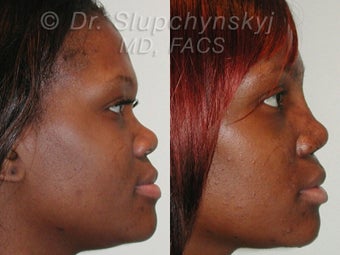 African American Rhinoplasty Revision before 613847