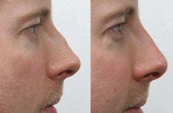 Rhinoplasty before 225887