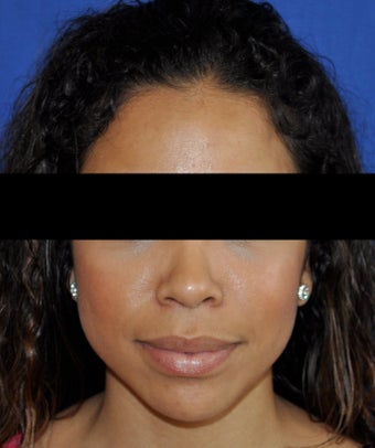 African American Rhinoplasty after 364917