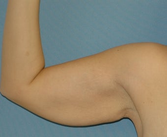 Brachioplasty before 560843