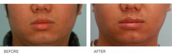 Lip Reduction/Lip Correction before 136740