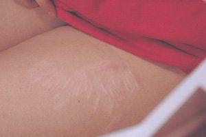 Laser resurfacing for cutting scars after 199407