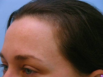 Melasma Treatment after 590841