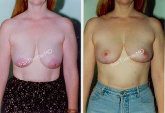 Breast Lift before 243695