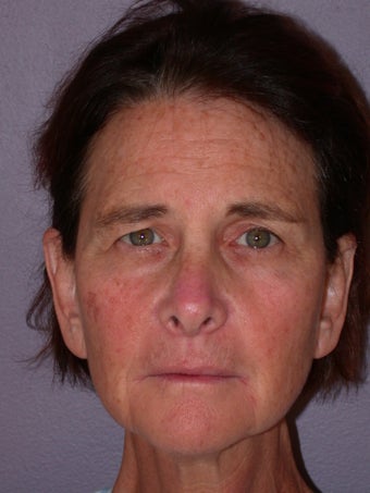 Neck lift before 306410