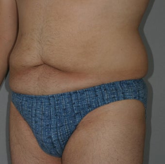 Male Abdominoplasty 586638