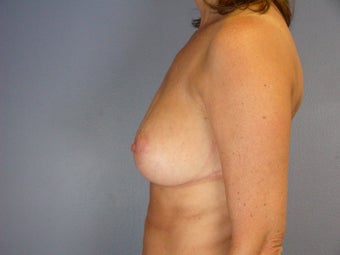 Breast Reduction after 306348