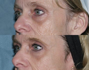 Fraxel repair with C02/Erbium lasers for upper lip wrinkles before 104313