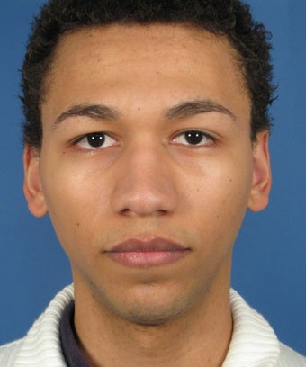 African American Rhinoplasty before 564691