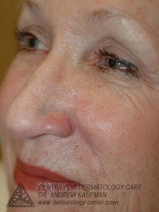 Mohs Surgery of Basal Cell Carcinoma and Recontruction 315015