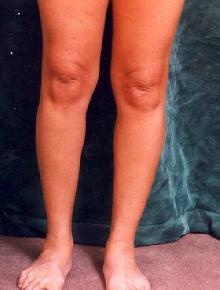Women's Calf Augmentation 519045
