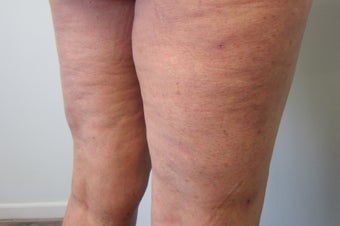 Cellulaze after 583409