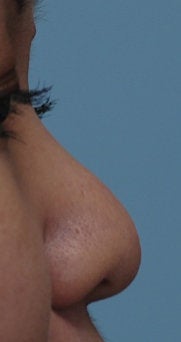 Non Surgical Rhinoplasty before 308302