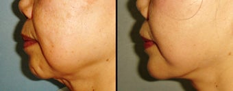 Chin Augmentation before 649420