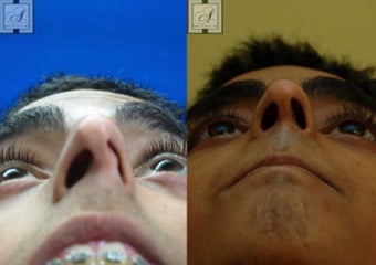 Septoplasty before 346257