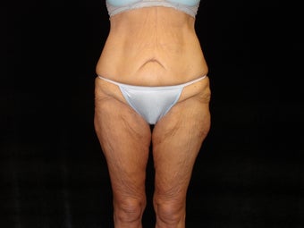 Body Lift with Liposuction of Abdomen, Waist, and Flanks before 203468