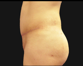 Andominoplasty after 458930