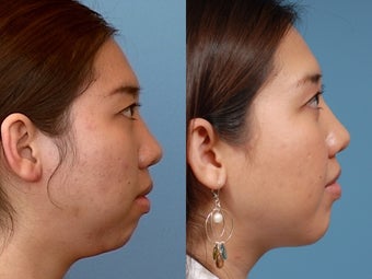 Chin Augmentation before 409091