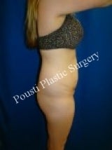 Liposuction, Tummy Tuck (Abdominoplasty) 632132