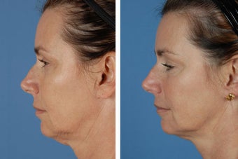 Radiesse & Botox Cosmetic 356479