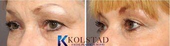 Botox before 519751