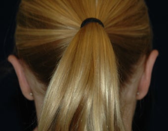 Otoplasty 565618