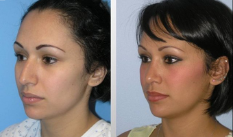 Rhinoplasty before 163633
