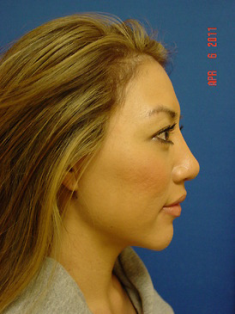 Chin Augmentation/rhinoplasty 383867