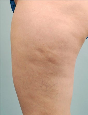 Smart Lipo before 606719