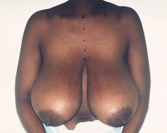 Breast Lift before 285340