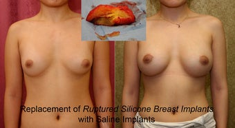 breast implants revision before 302665