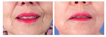 Restylane for nasolabial folds before 6264
