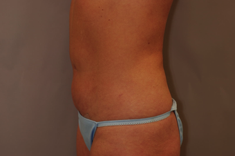 Tummy Liposuction after 229689