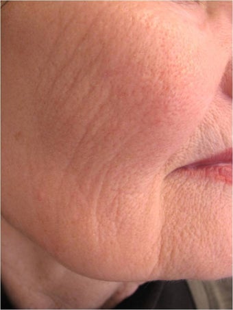 Evolastin- Non Surgical Lift 498659