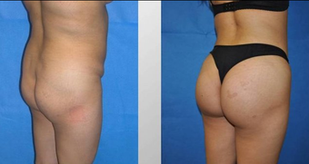 Butt Augmentation before 256430