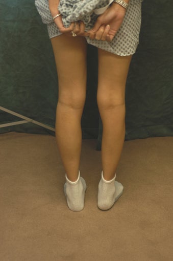 Women's Calf Augmentation before 519047