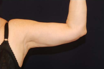 Liposuction before 286785
