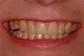 Zoom Advanced Power Inoffice Tooth Whitening before 190922