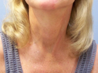 Neck lift after 591055