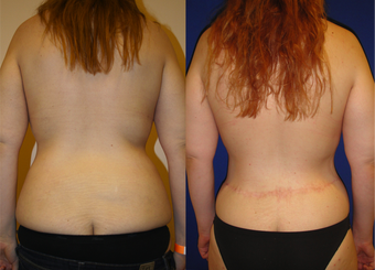 Lower Body lift, Breast Augmentation 543105