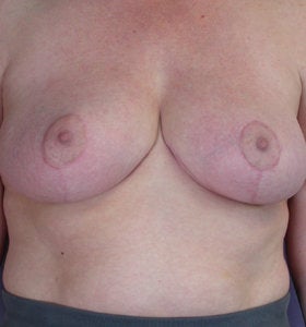 Breast Reduction after 285318