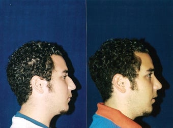 Rhinoplasty and Septoplasty after 241686